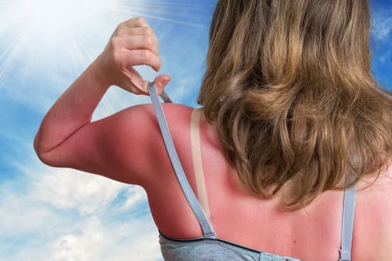 Woman with red sunburn around singlet top